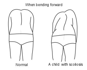 http://www.patient.co.uk/health/Scoliosis-%28Curvature-of-the-Spine%29.htm